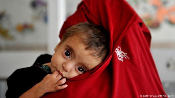 افزایش شدید شمار بچه ها مبتلا به سوء تغذیه در یمن