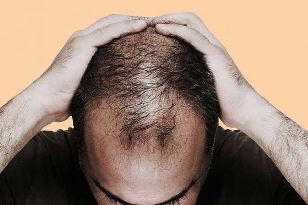 با خوردن این غذاها دیگر مو های تان نمی ریزد!
