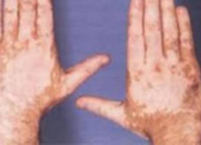 انواع سوختگی درجه یک، دو و سه