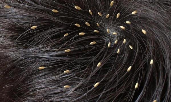 دانستنی های لازم در رابطه با شپش موی سر