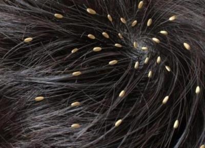 دانستنی های لازم در رابطه با شپش موی سر